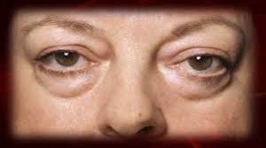 CÓMO ELIMINAR OJERAS, BOLSAS Y ARRUGAS DE LOS OJOS CON REMEDIOS NATURALES
