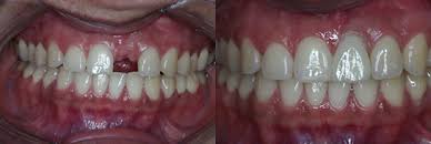 Implantes dentales