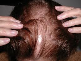Conoce todo lo relativo a la alopecia androgenica en mujeres