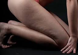 celulitis en las piernas: 4 buenos consejos para evitar su aparicion