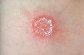 Hongos En La Piel: Conoce varias Maneras De Prevenirlos y curarlos