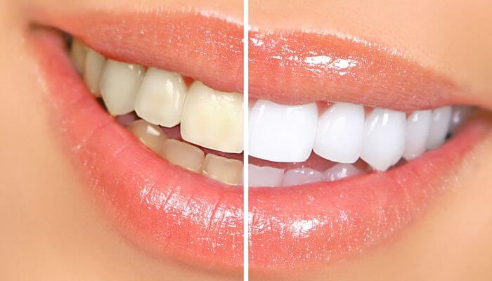 6 Fantasticos Remedios Caseros para Blanquear los Dientes