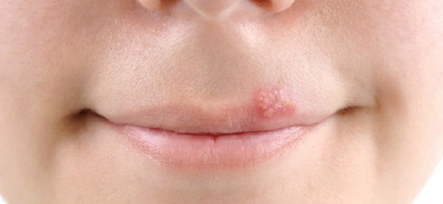Remedios Caseros para el Herpes de Piel Súper Efectivos!!