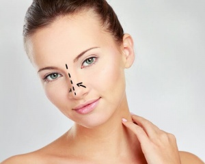 rinoplastia